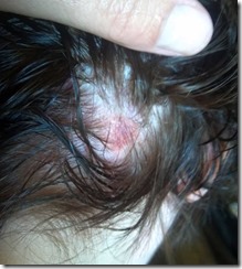 Spider Bite on Head